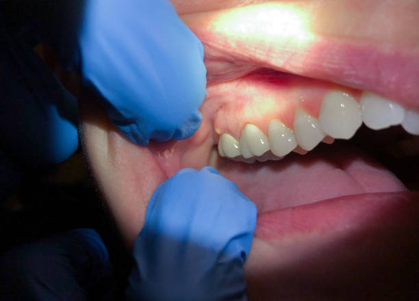 Best Emergency Dentist for Knocked-Out Tooth in San Leandro, CA